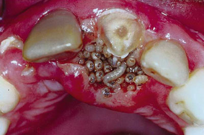 Featured image of post Dentes Podres Com Larvas Segure a fita ou fio dental com a ponta dos dedos e introduza delicadamente entre os dentes at que ela se encoste na gengiva