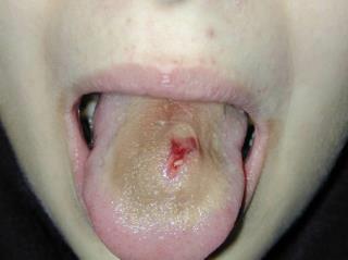 Piercing na boca: como cuidar, cicatrizar e evitar inflamação