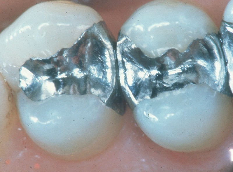 Dentistas discordam do projeto que veta o uso do amálgama