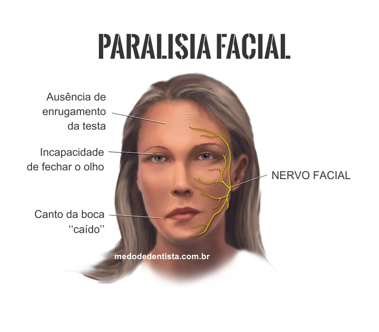 Paralisia facial