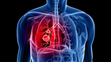 Doença Pulmonar